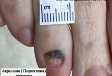 Photo of Рак кожи: как защититься от солнечных лучей